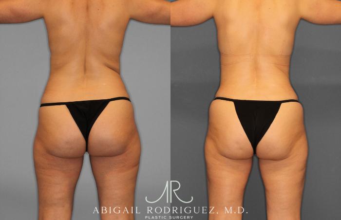 Before & After Tummy Tuck Case 258509 View 6 View in Houston, TX