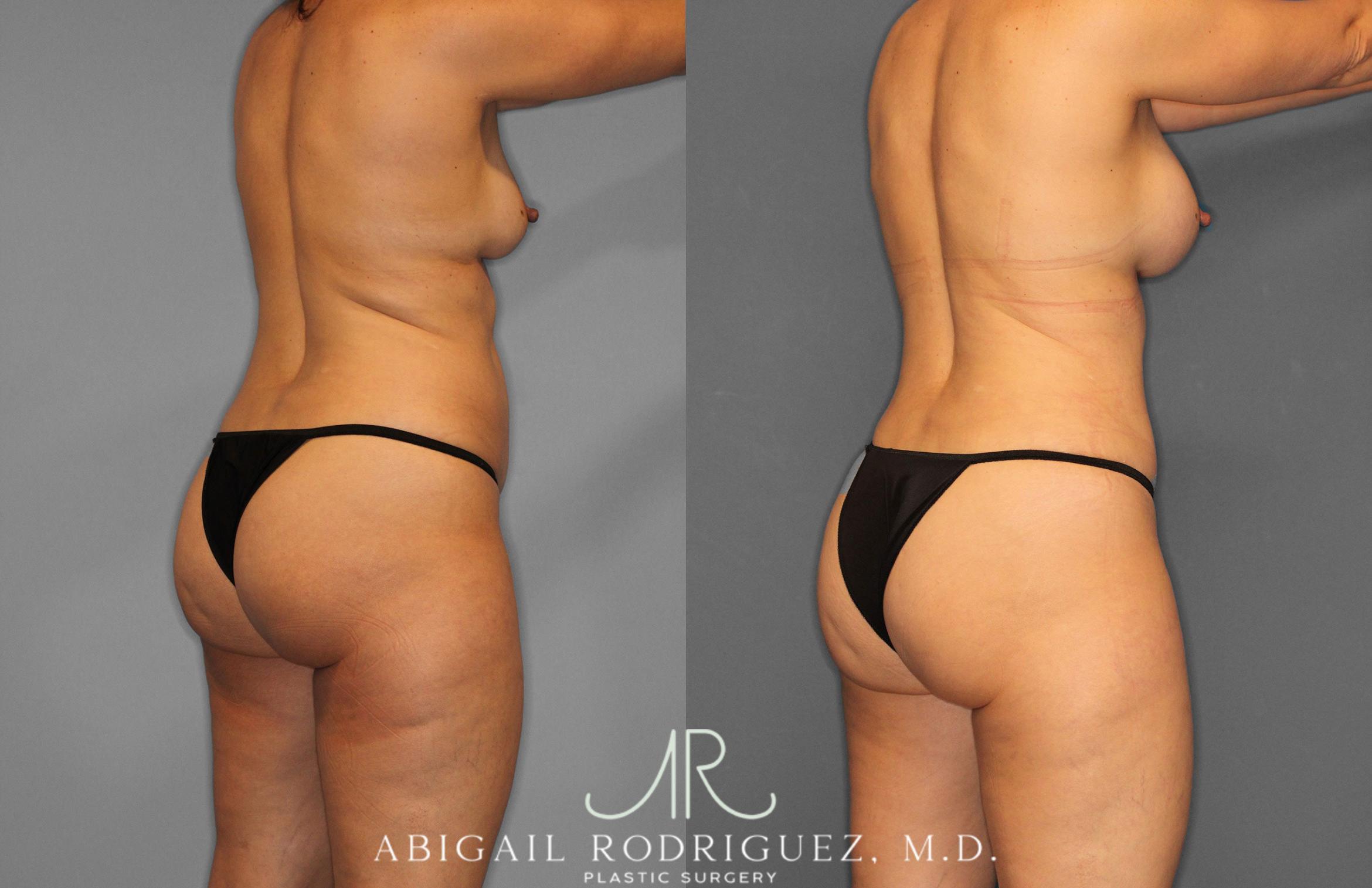 Before & After Tummy Tuck Case 258509 View 7 View in Houston, TX