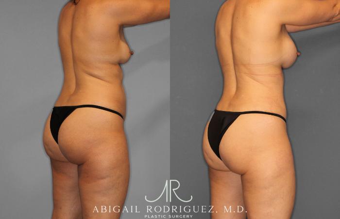 Before & After Tummy Tuck Case 258509 View 7 View in Houston, TX