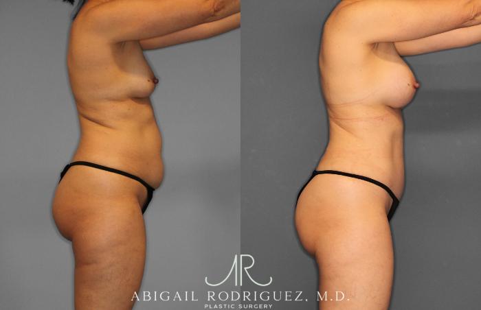 Before & After Tummy Tuck Case 258509 View 8 View in Houston, TX