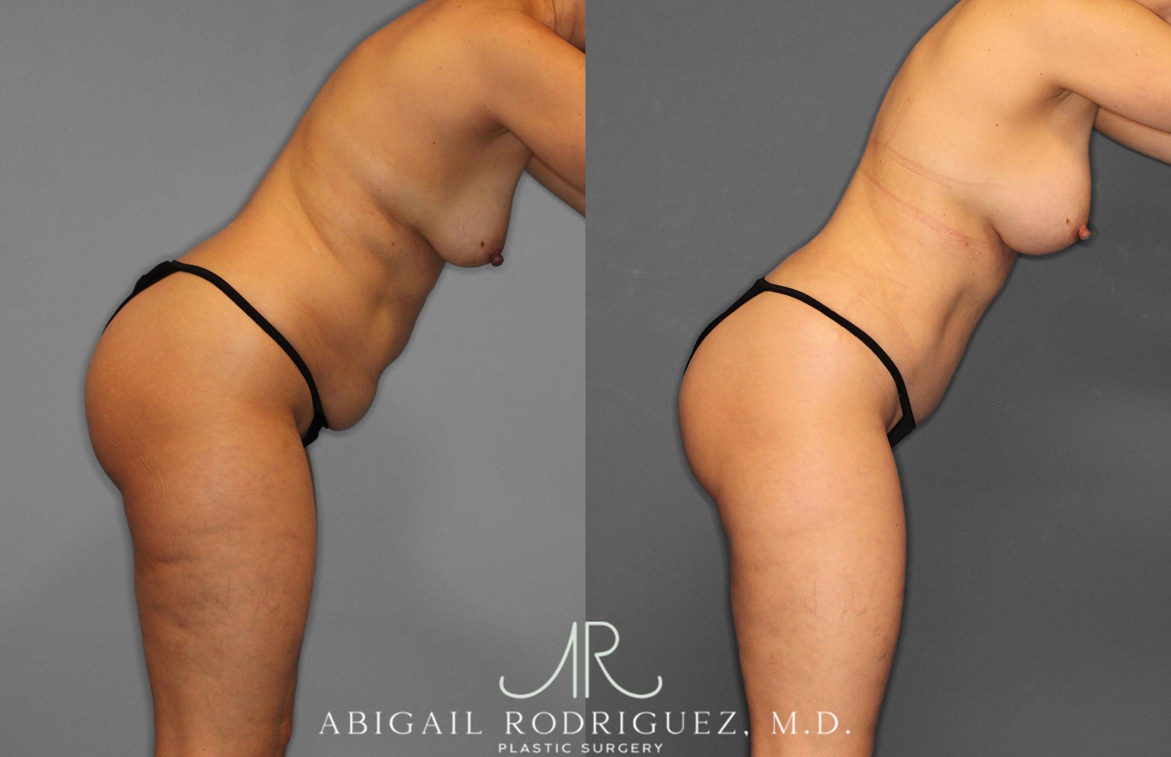 Before & After Tummy Tuck Case 258509 View 9 View in Houston, TX