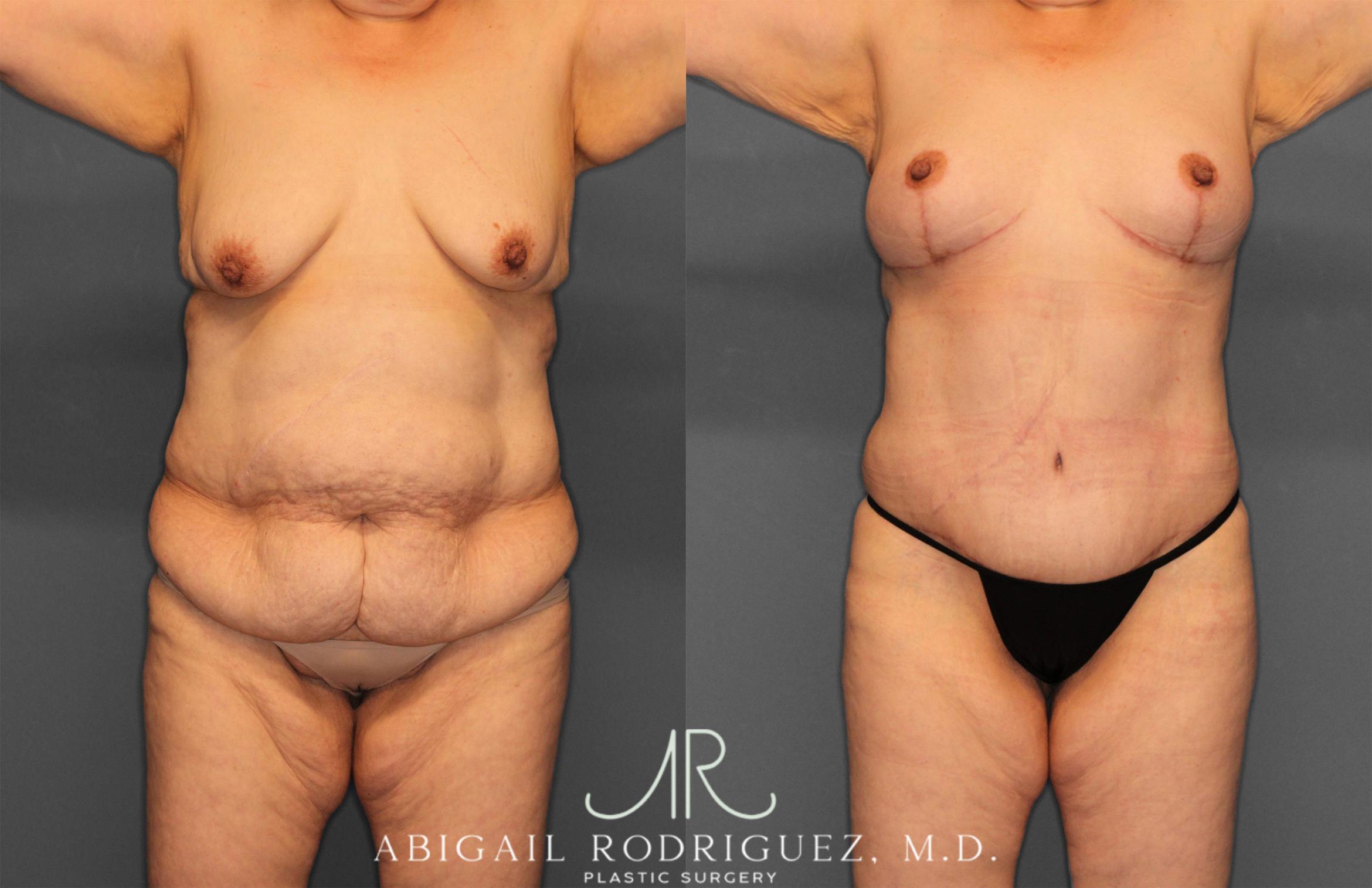 Before & After Tummy Tuck Case 258531 View 1 View in Houston, TX