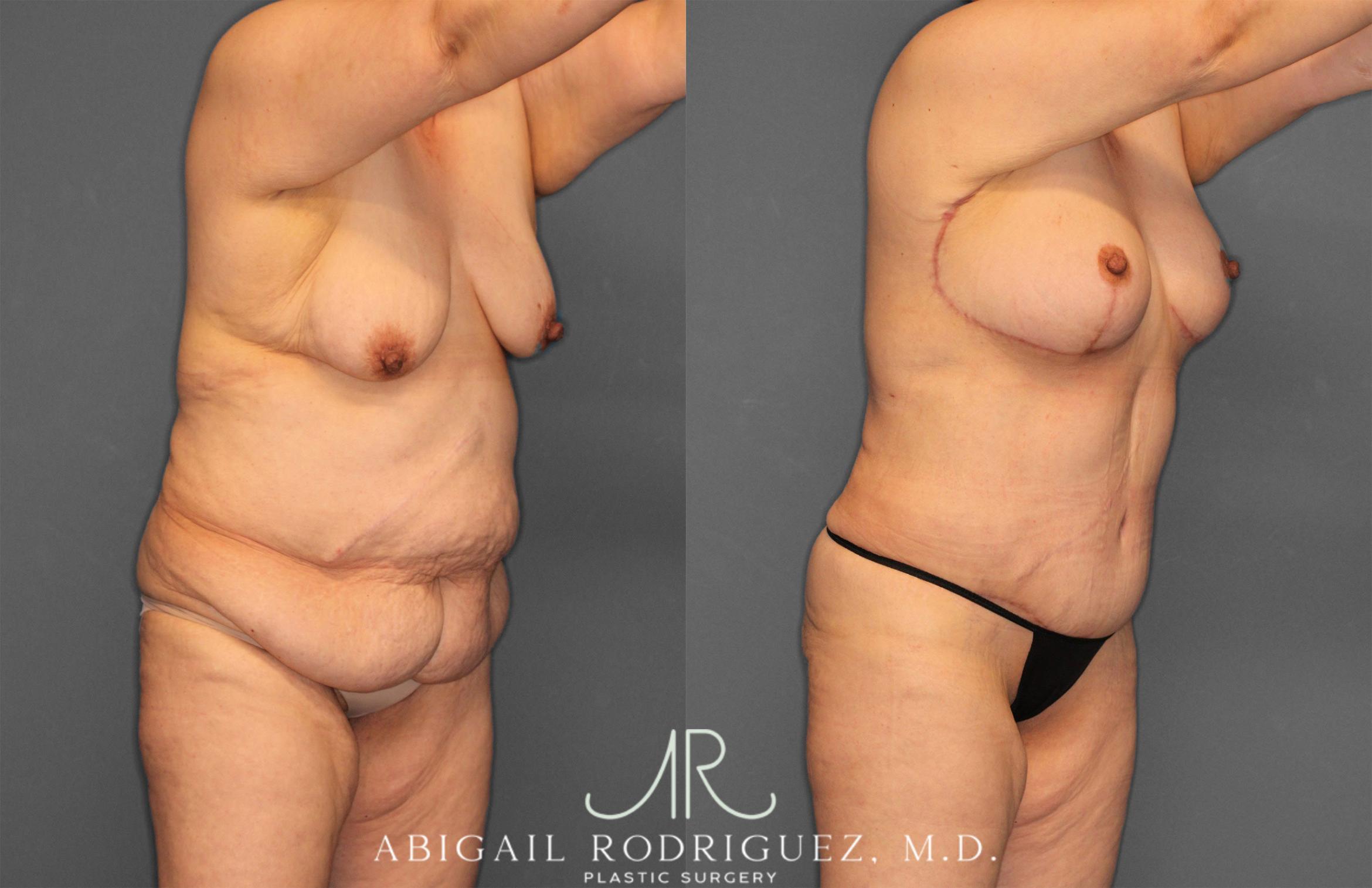 Before & After Tummy Tuck Case 258531 View 10 View in Houston, TX