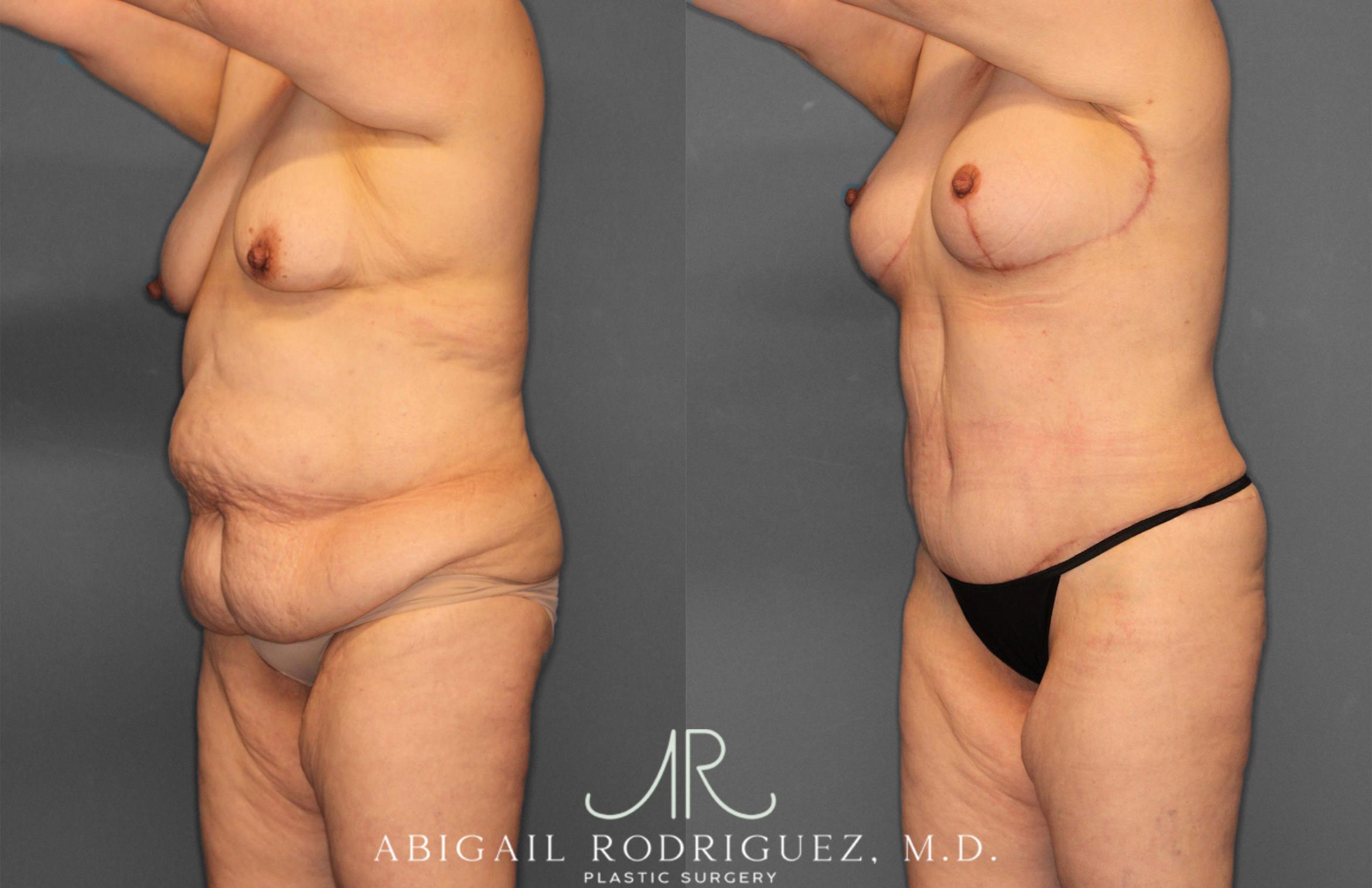 Before & After Tummy Tuck Case 258531 View 2 View in Houston, TX