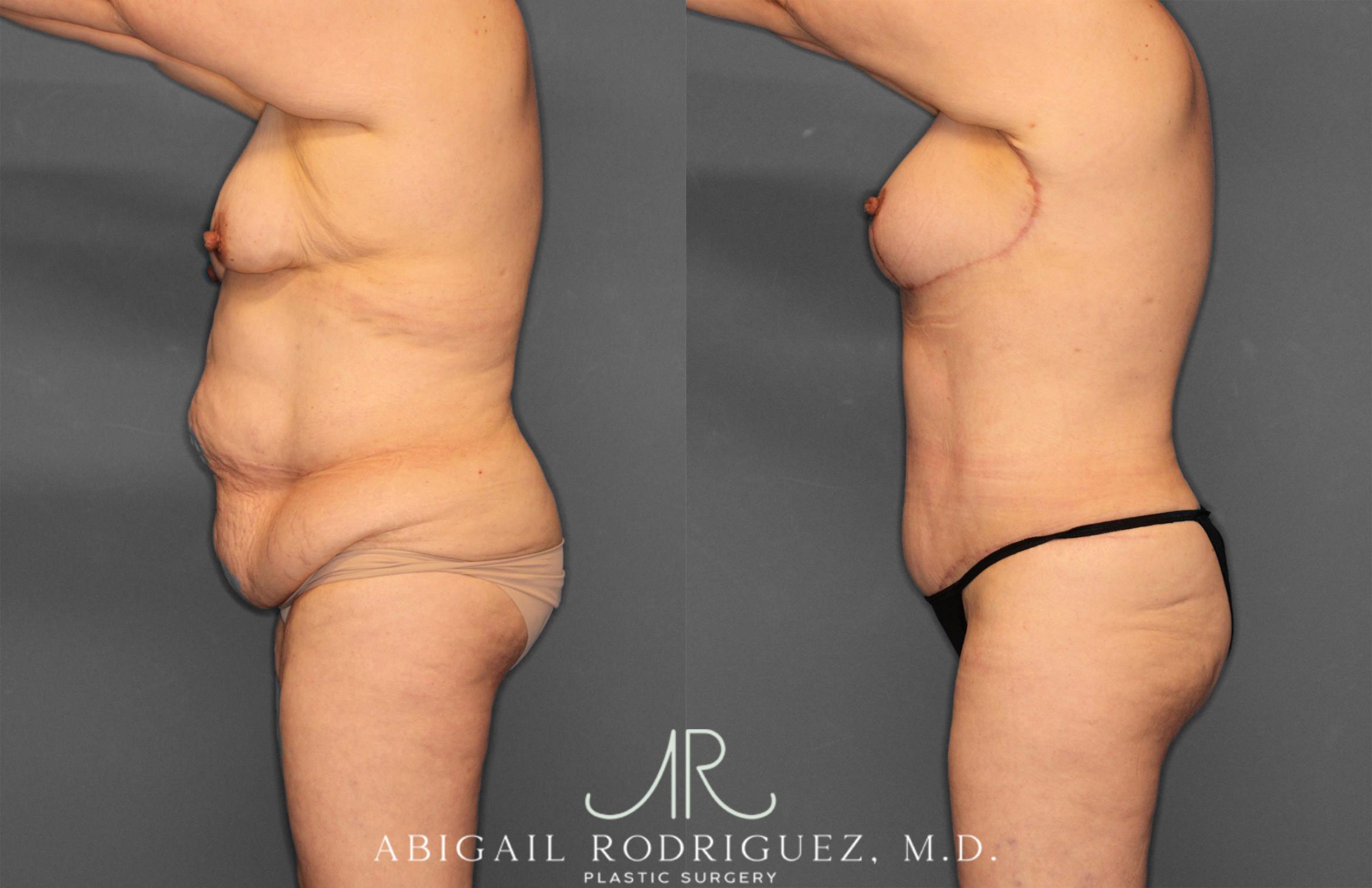 Before & After Tummy Tuck Case 258531 View 3 View in Houston, TX
