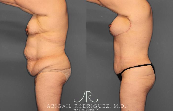 Before & After Tummy Tuck Case 258531 View 3 View in Houston, TX