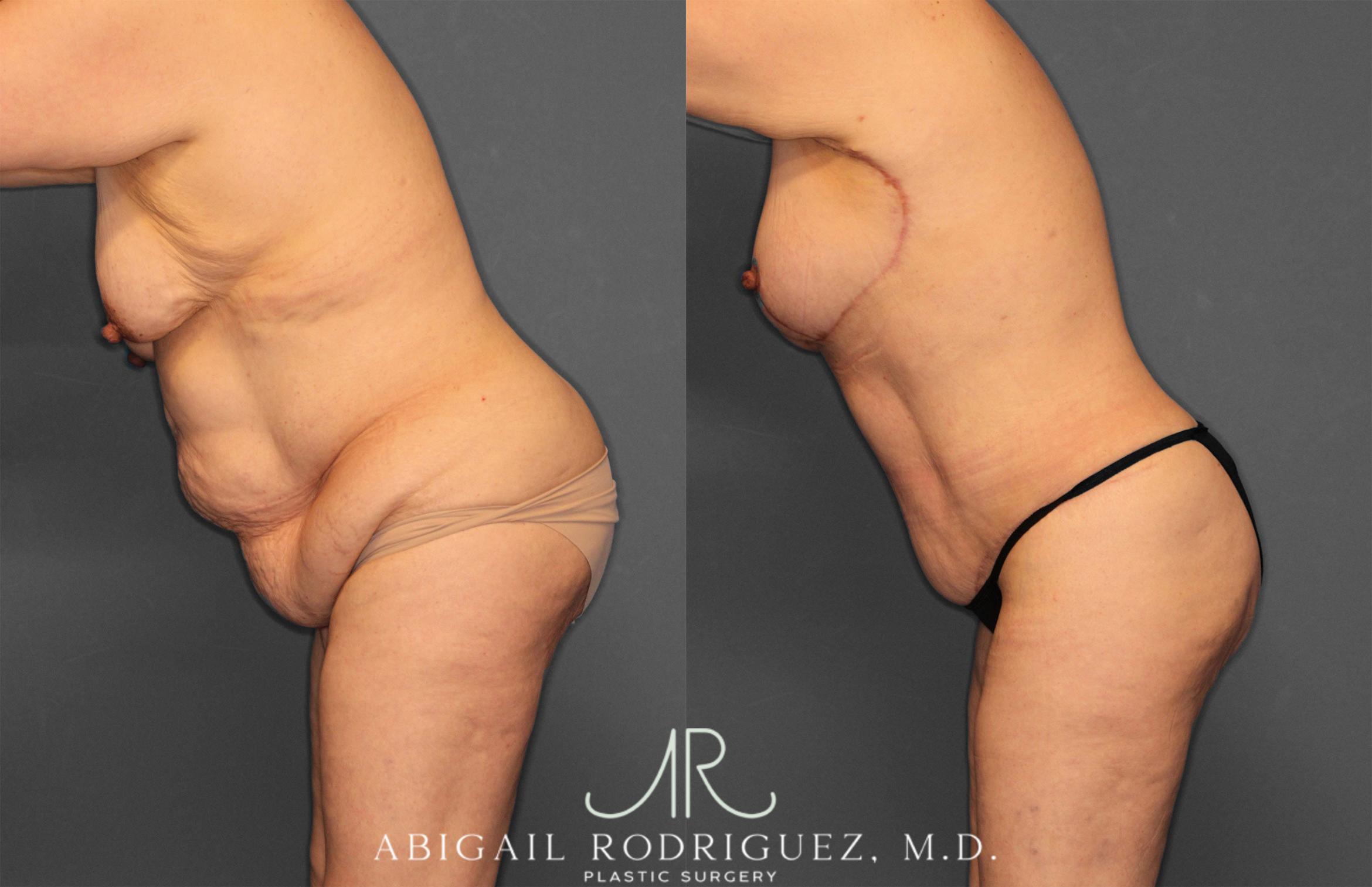Before & After Tummy Tuck Case 258531 View 4 View in Houston, TX