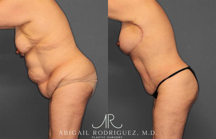 Before & After Tummy Tuck Case 258531 View 4 View in Houston, TX