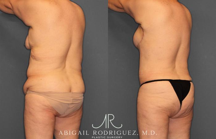Before & After Tummy Tuck Case 258531 View 5 View in Houston, TX