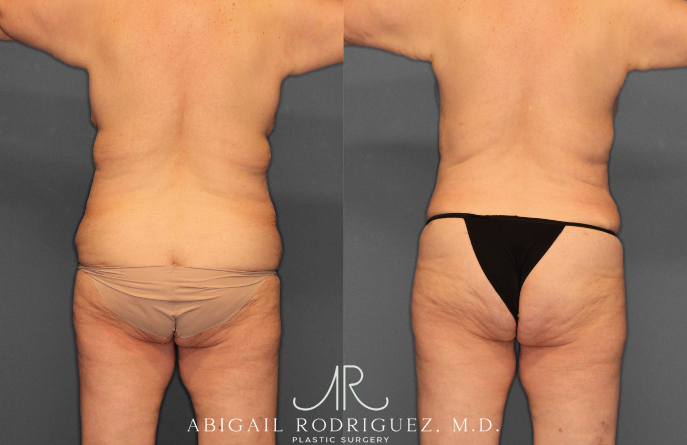 Before & After Tummy Tuck Case 258531 View 6 View in Houston, TX