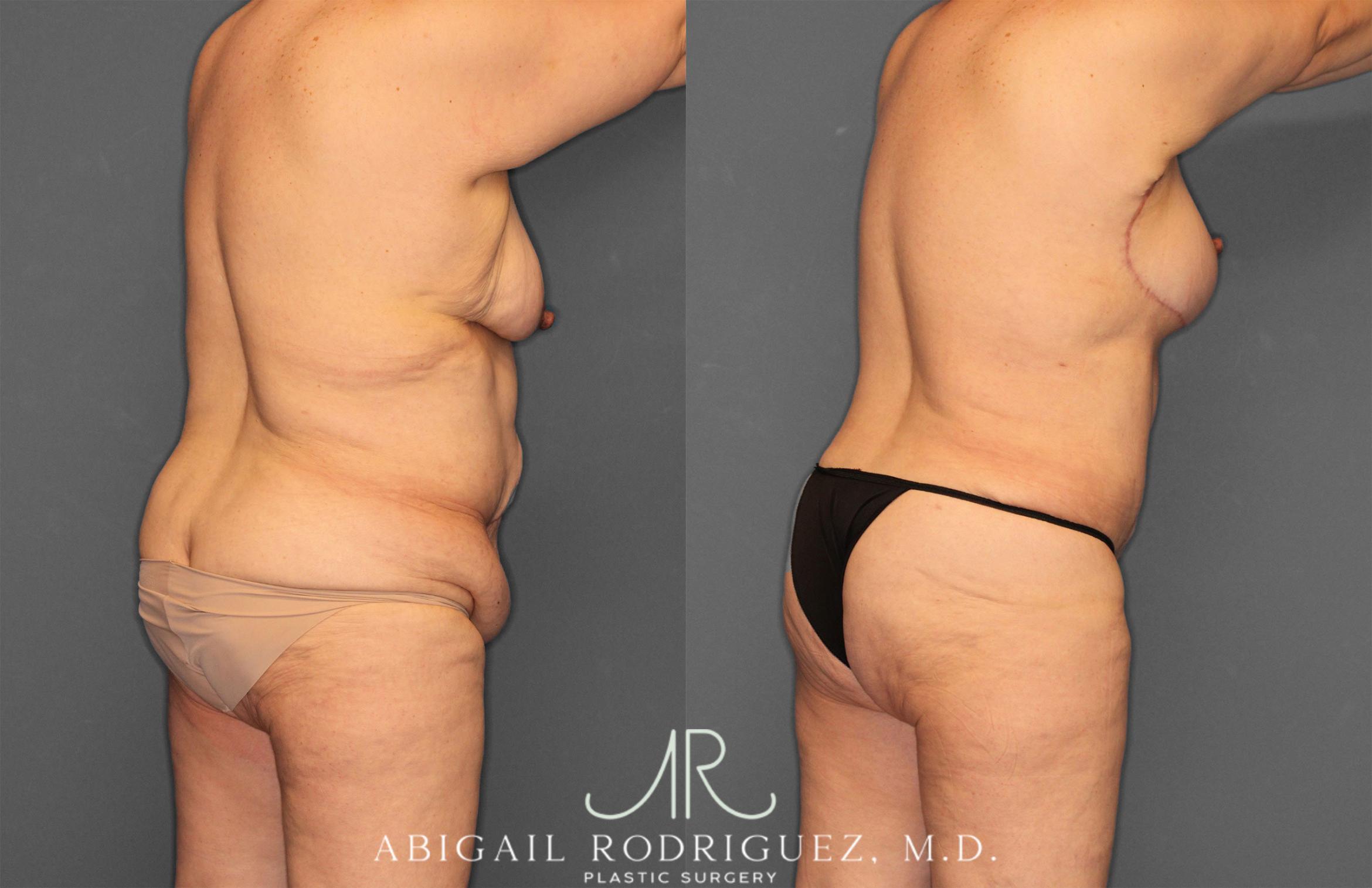 Before & After Tummy Tuck Case 258531 View 7 View in Houston, TX