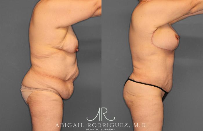 Before & After Tummy Tuck Case 258531 View 8 View in Houston, TX