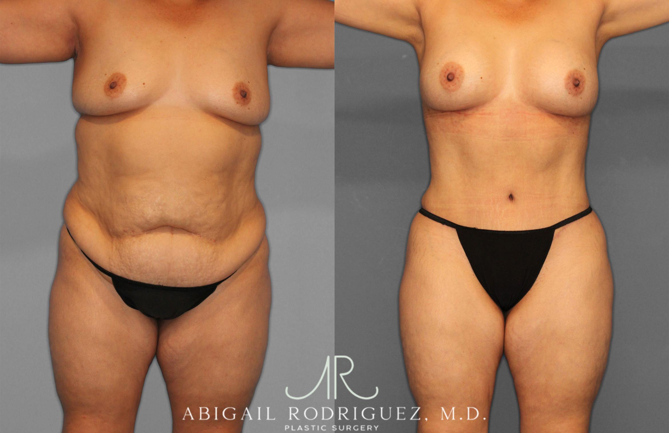 Before & After Tummy Tuck Case 258612 View 1 View in Houston, TX