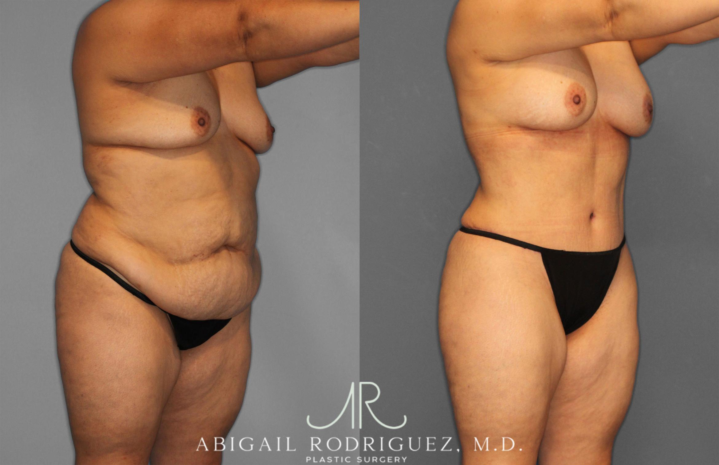 Before & After Tummy Tuck Case 258612 View 10 View in Houston, TX