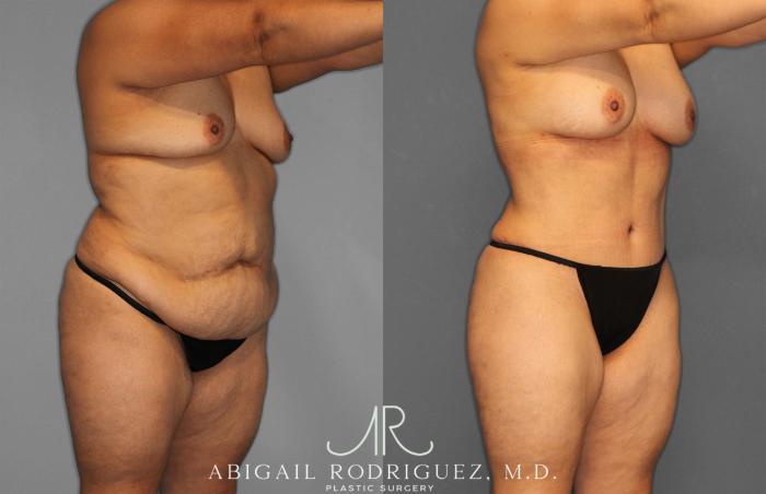 Before & After Tummy Tuck Case 258612 View 10 View in Houston, TX