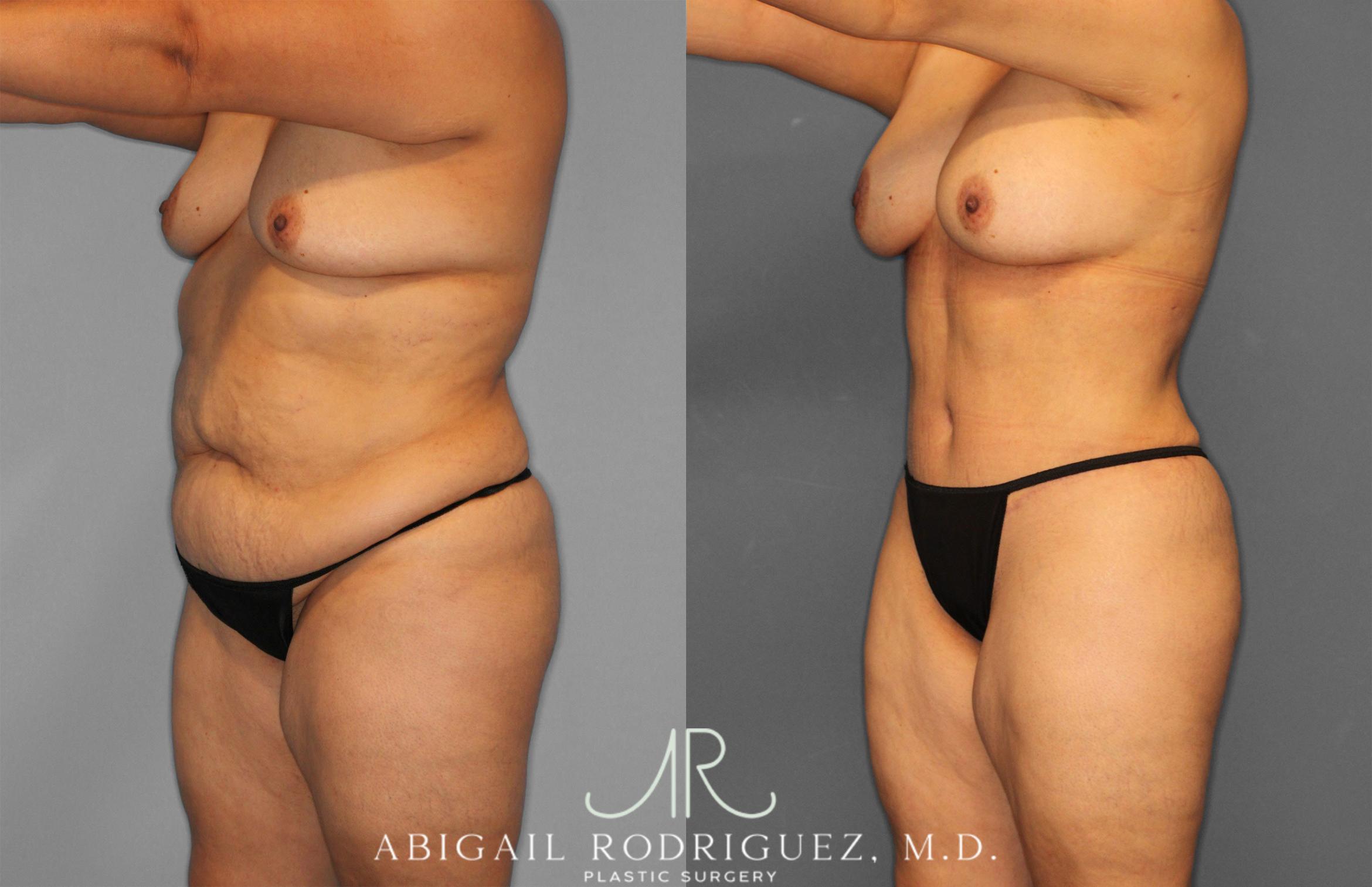 Before & After Tummy Tuck Case 258612 View 2 View in Houston, TX
