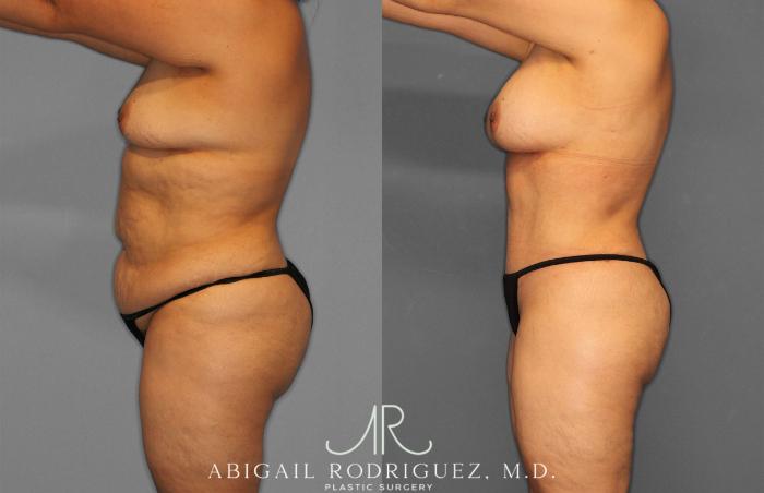 Before & After Tummy Tuck Case 258612 View 3 View in Houston, TX