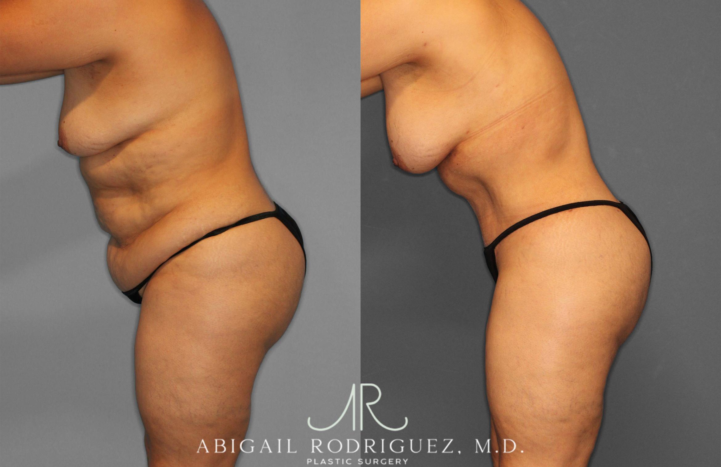 Before & After Tummy Tuck Case 258612 View 4 View in Houston, TX