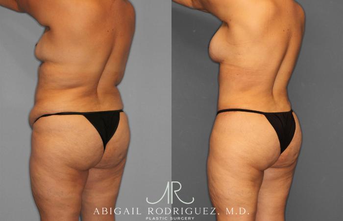 Before & After Tummy Tuck Case 258612 View 5 View in Houston, TX