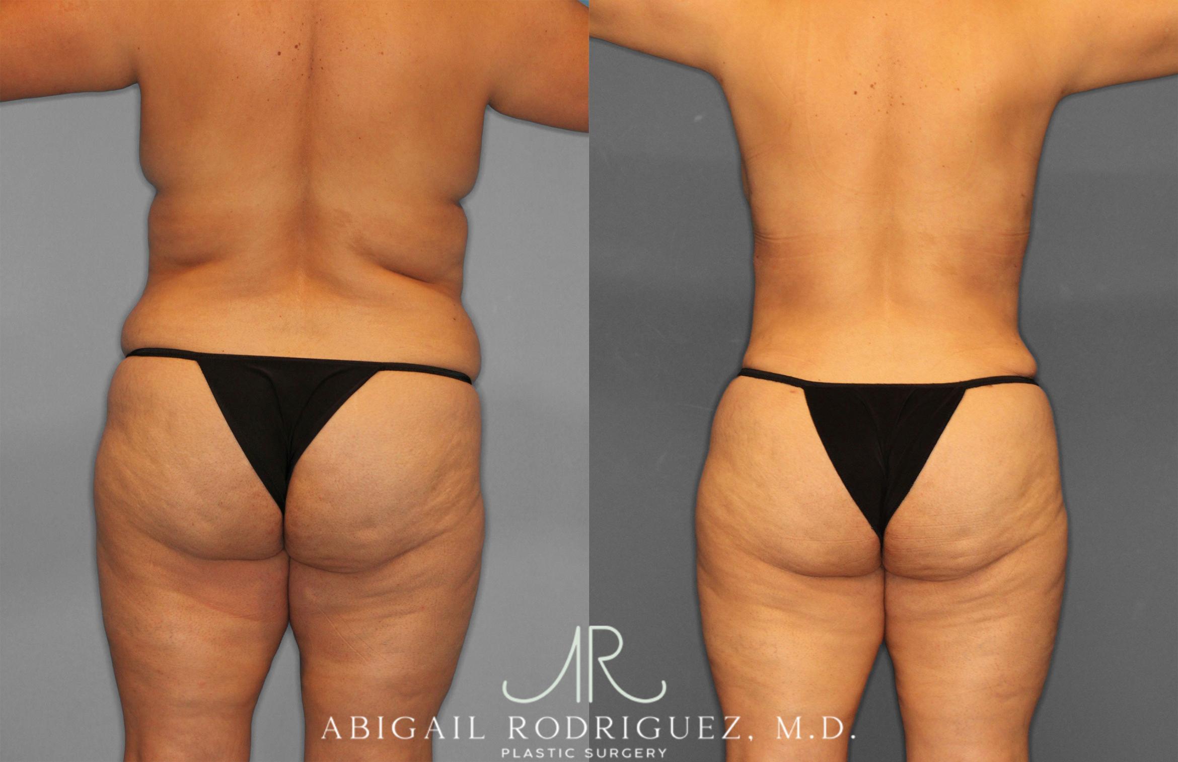 Before & After Tummy Tuck Case 258612 View 6 View in Houston, TX