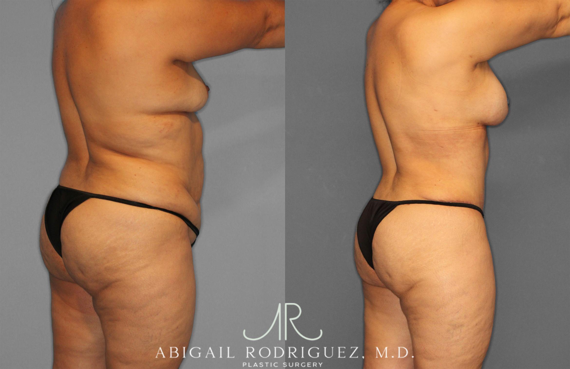 Before & After Tummy Tuck Case 258612 View 7 View in Houston, TX