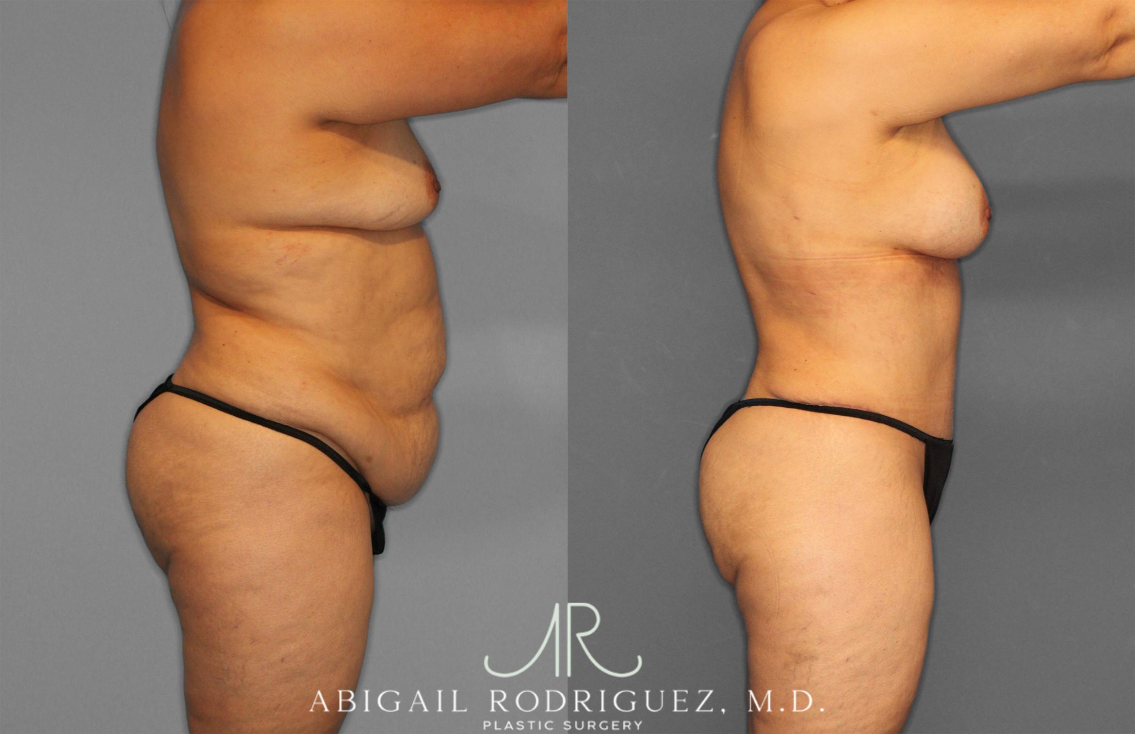 Before & After Tummy Tuck Case 258612 View 8 View in Houston, TX