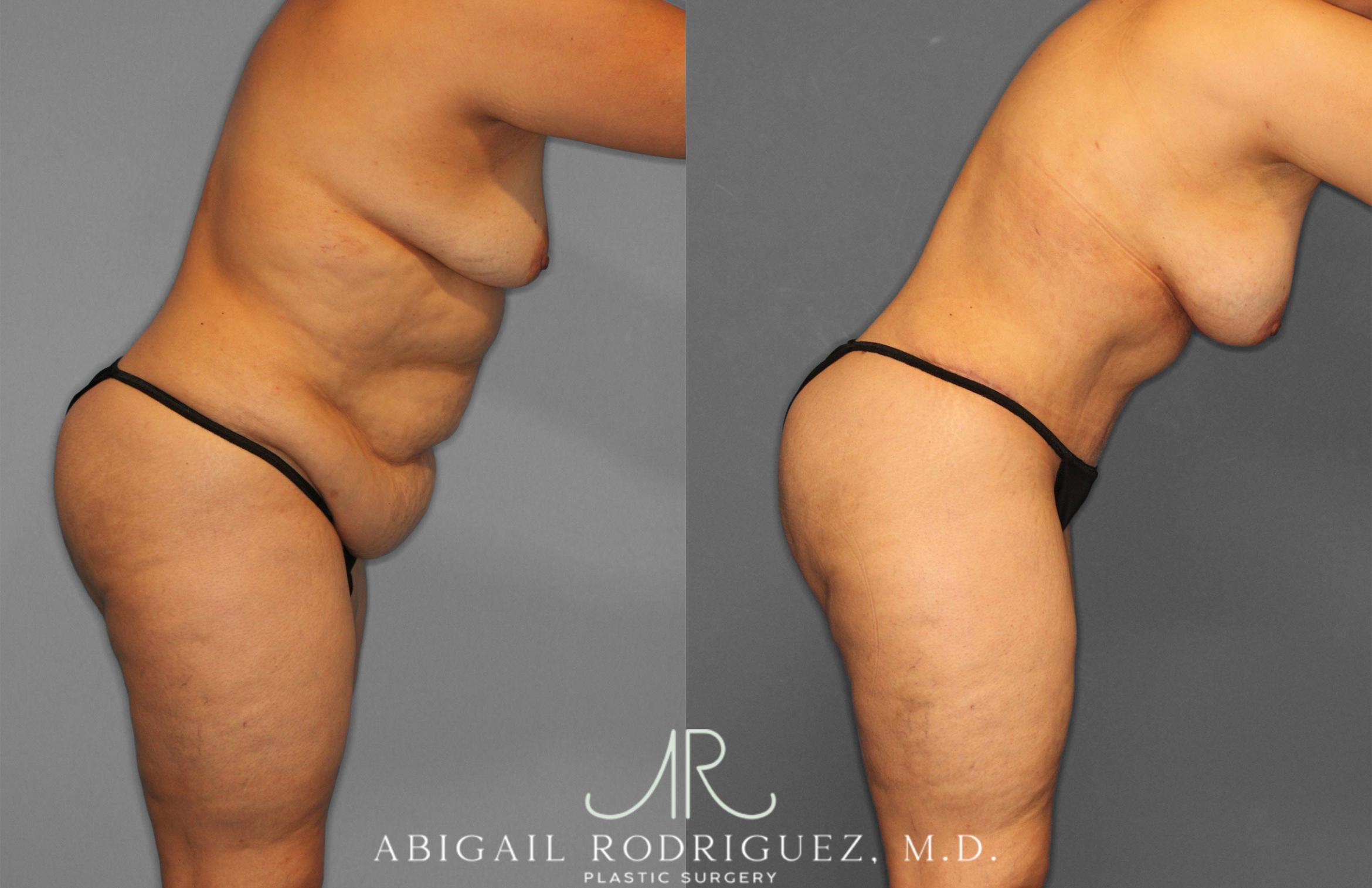 Before & After Tummy Tuck Case 258612 View 9 View in Houston, TX