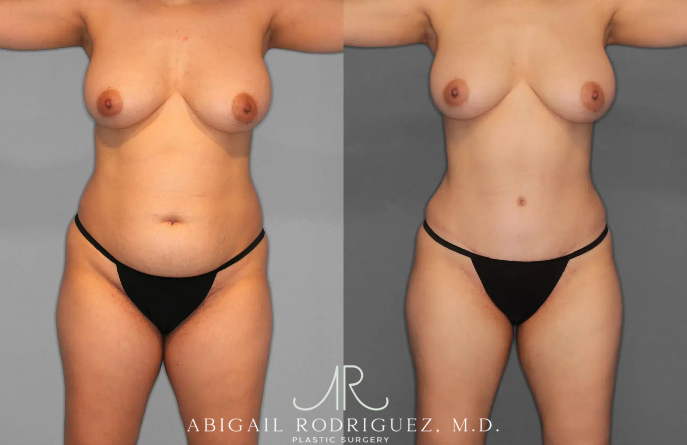 Before & After Tummy Tuck Case 259012 View 1 View in Houston, TX
