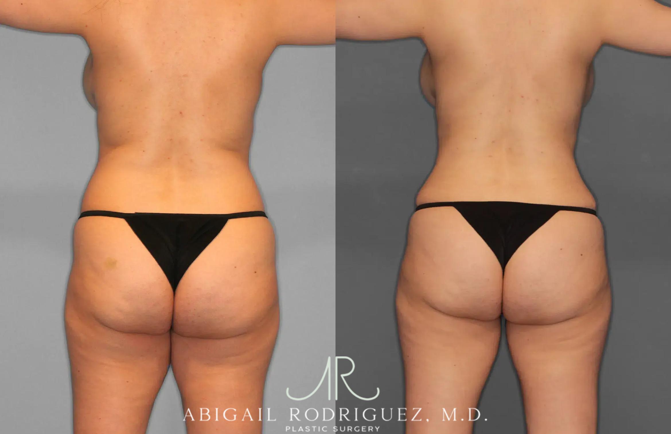 Before & After Tummy Tuck Case 259012 View 10 View in Houston, TX