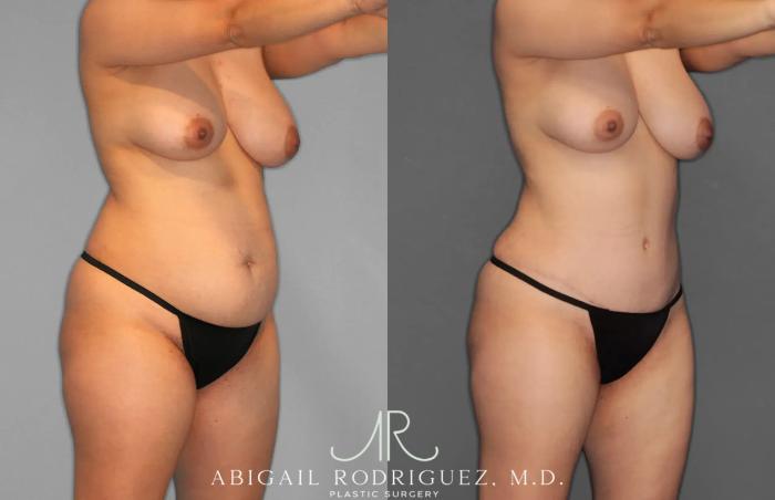 Before & After Tummy Tuck Case 259012 View 2 View in Houston, TX