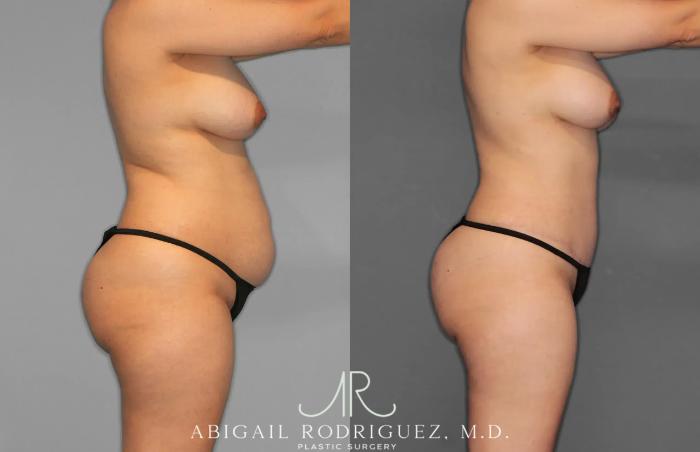 Before & After Tummy Tuck Case 259012 View 3 View in Houston, TX