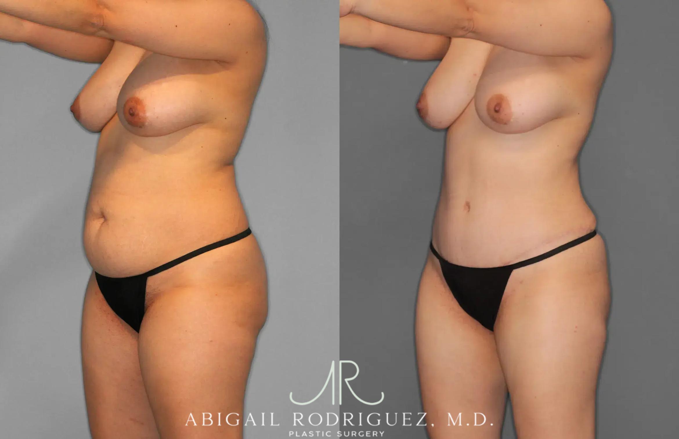 Before & After Tummy Tuck Case 259012 View 4 View in Houston, TX
