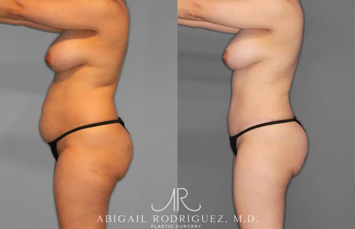 Before & After Tummy Tuck Case 259012 View 5 View in Houston, TX