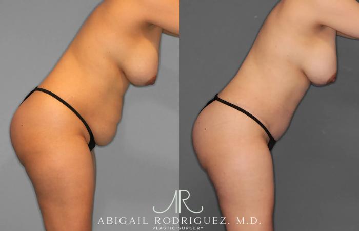 Before & After Tummy Tuck Case 259012 View 6 View in Houston, TX