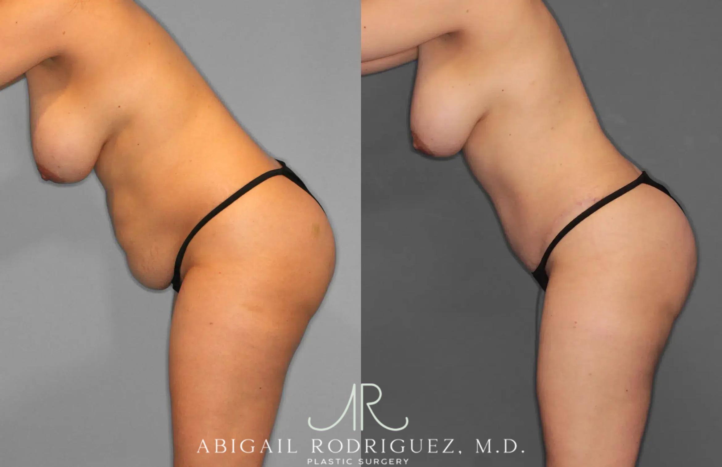Before & After Tummy Tuck Case 259012 View 7 View in Houston, TX