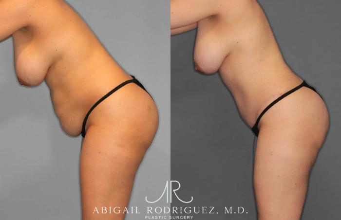 Before & After Tummy Tuck Case 259012 View 7 View in Houston, TX
