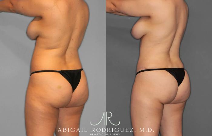 Before & After Tummy Tuck Case 259012 View 8 View in Houston, TX