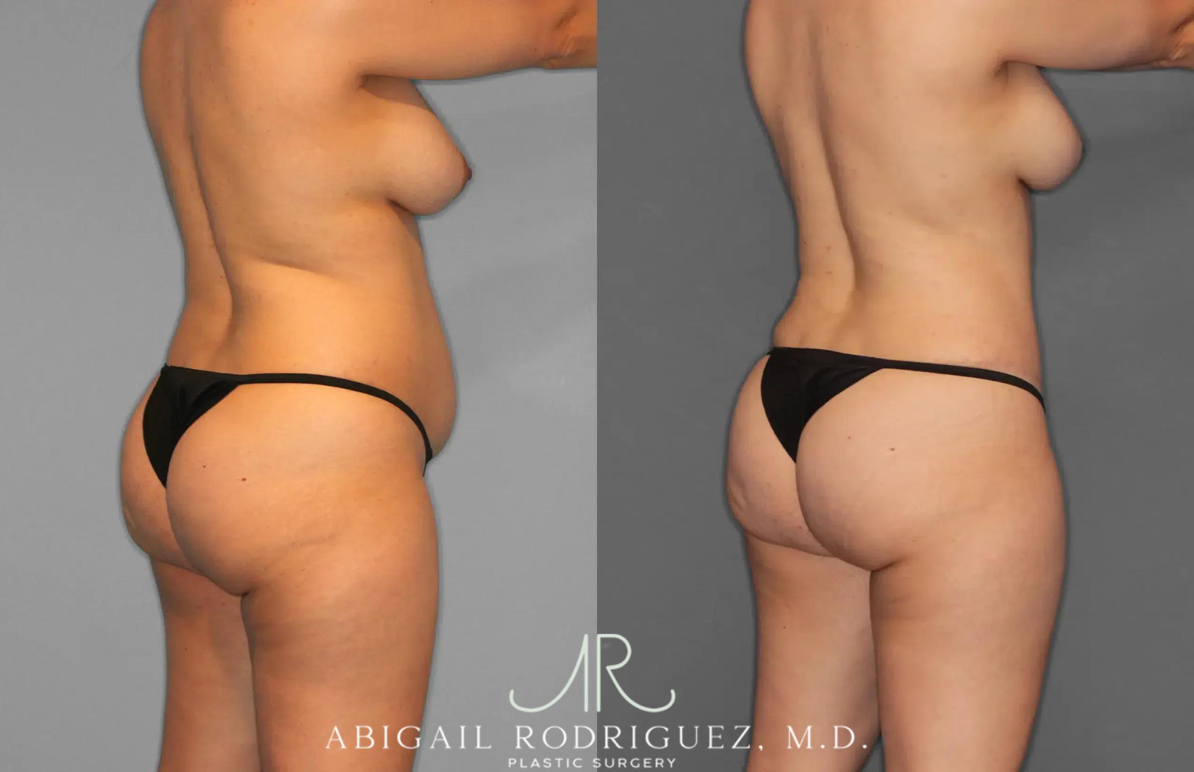 Before & After Tummy Tuck Case 259012 View 9 View in Houston, TX