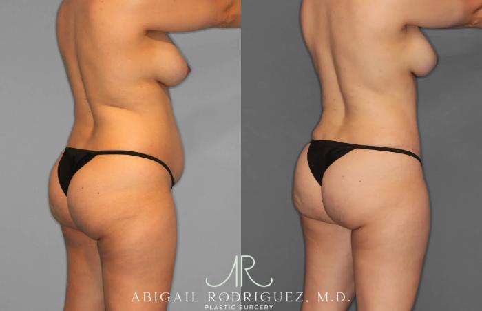Before & After Tummy Tuck Case 259012 View 9 View in Houston, TX