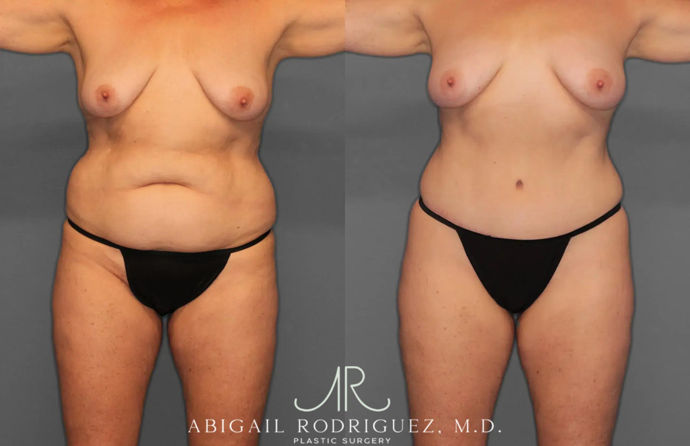 Before & After Tummy Tuck Case 259028 View 1 View in Houston, TX