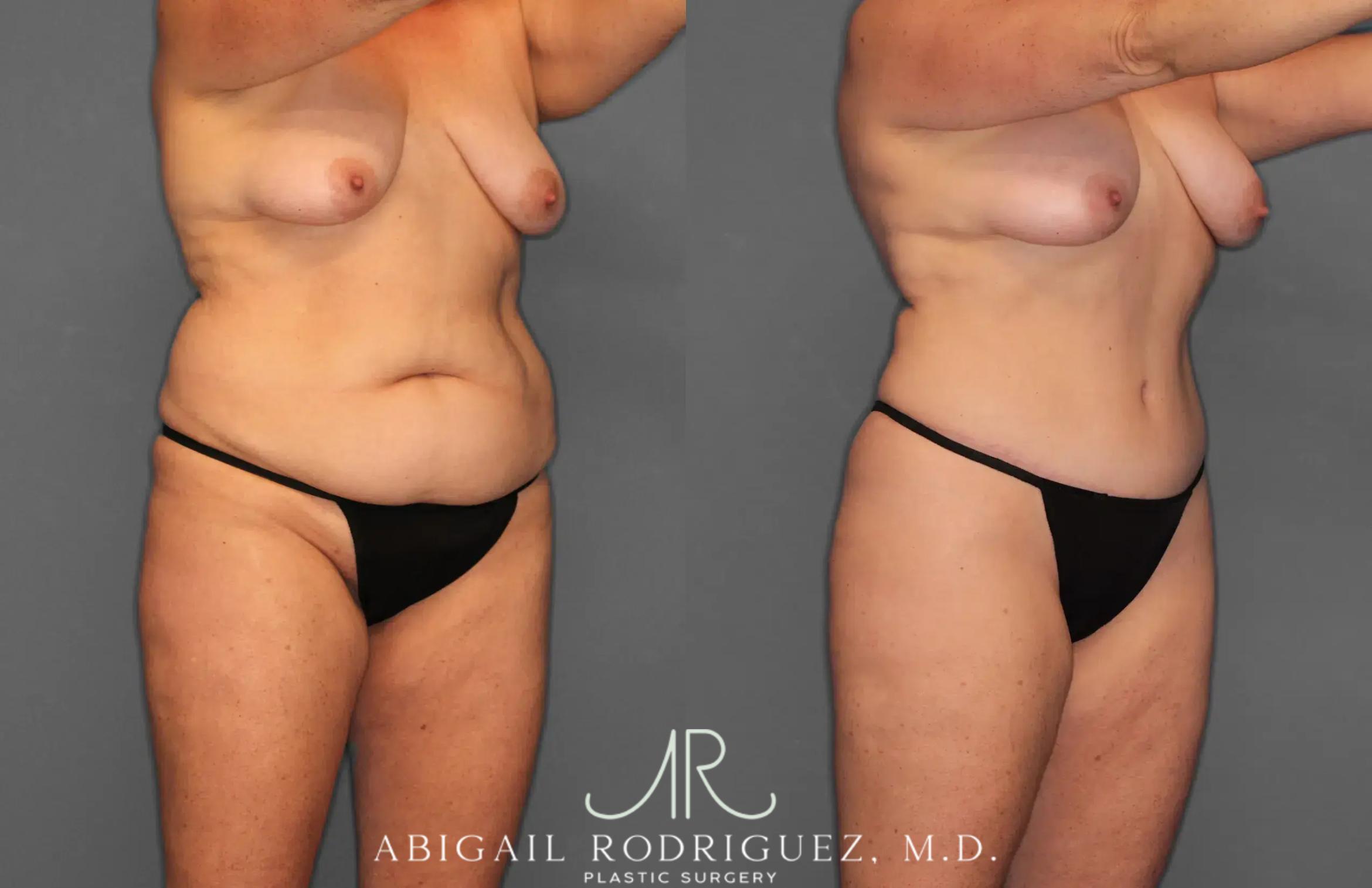 Before & After Tummy Tuck Case 259028 View 10 View in Houston, TX