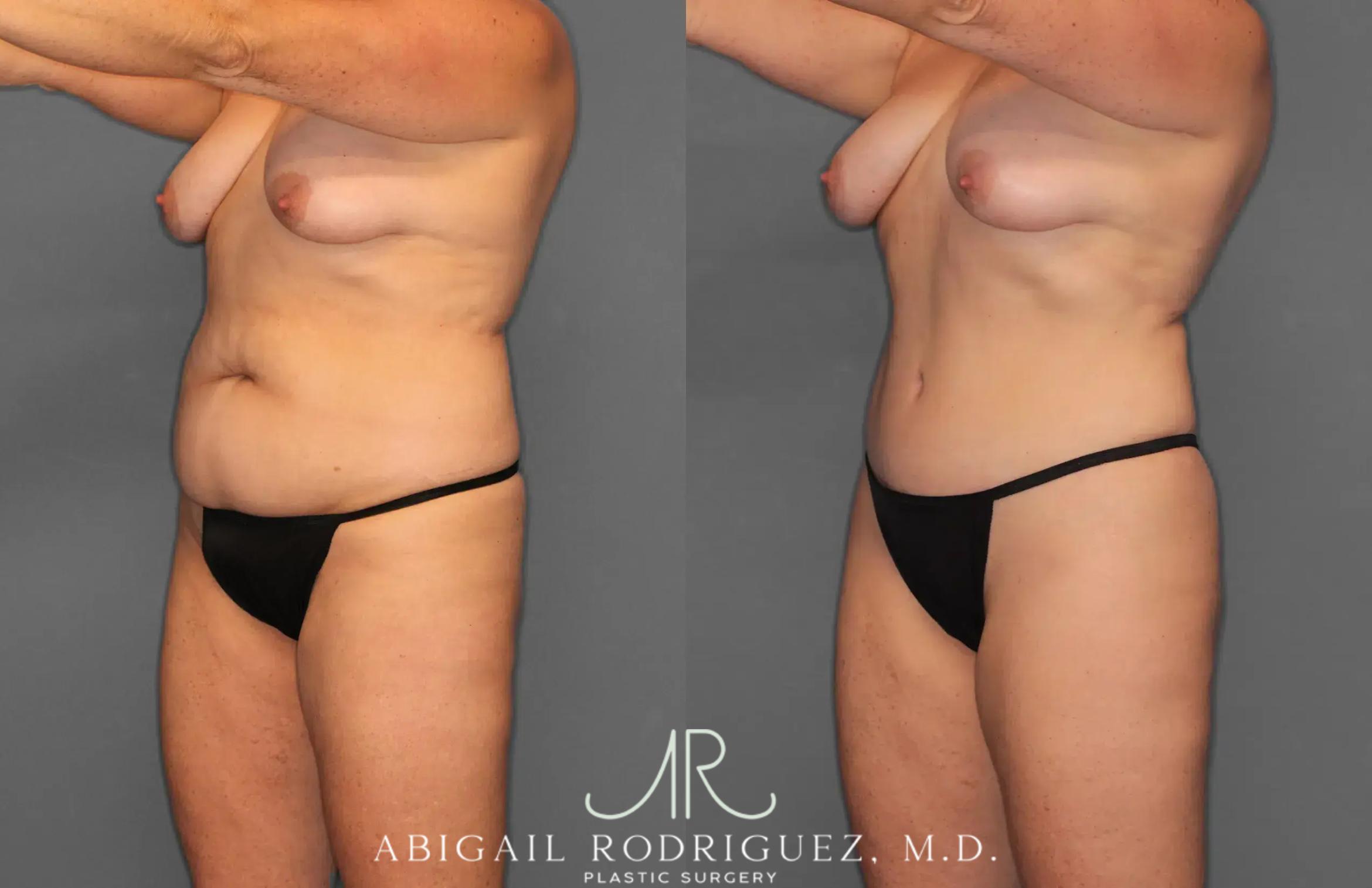 Before & After Tummy Tuck Case 259028 View 2 View in Houston, TX