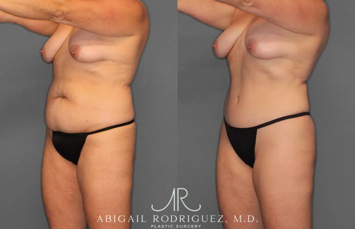 Before & After Tummy Tuck Case 259028 View 2 View in Houston, TX