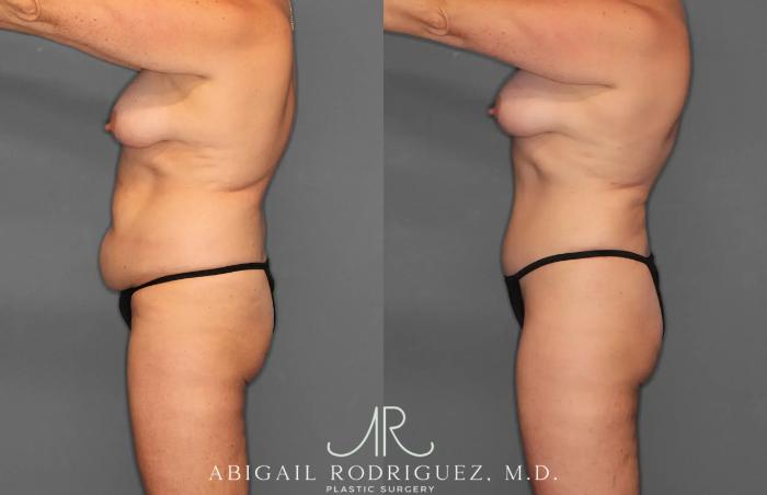 Before & After Tummy Tuck Case 259028 View 3 View in Houston, TX