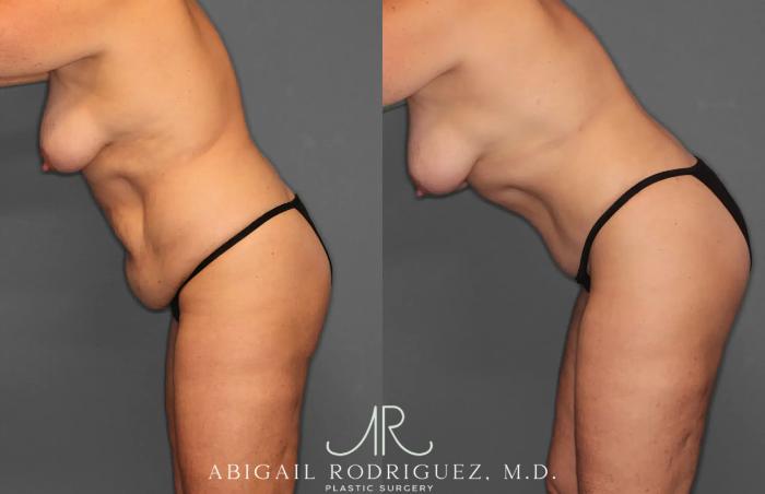 Before & After Tummy Tuck Case 259028 View 4 View in Houston, TX