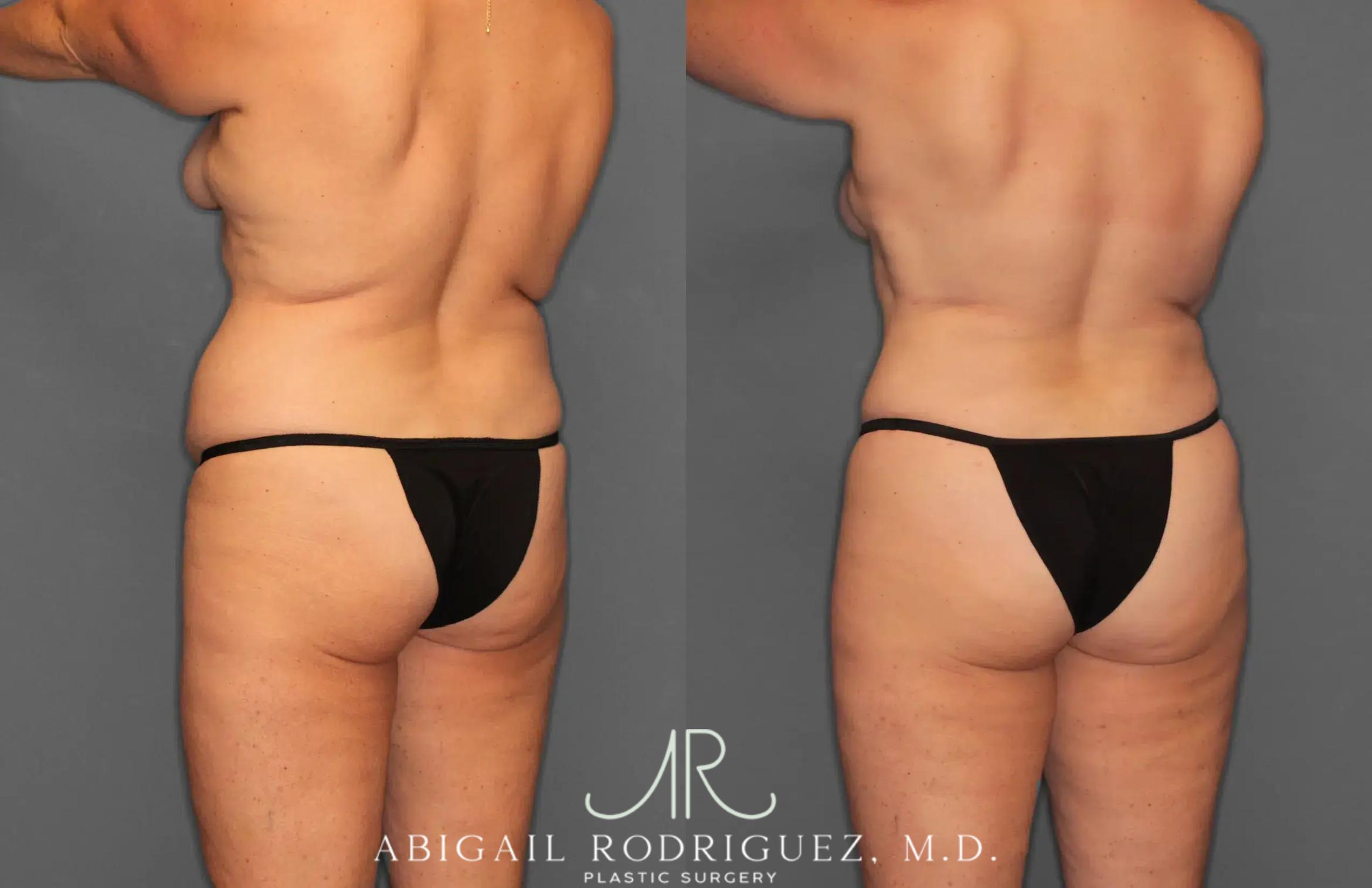 Before & After Tummy Tuck Case 259028 View 5 View in Houston, TX