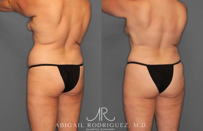 Before & After Tummy Tuck Case 259028 View 5 View in Houston, TX