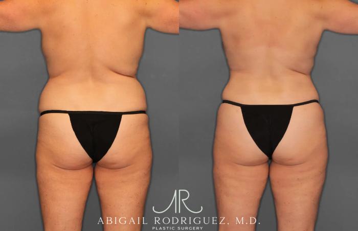 Before & After Tummy Tuck Case 259028 View 6 View in Houston, TX