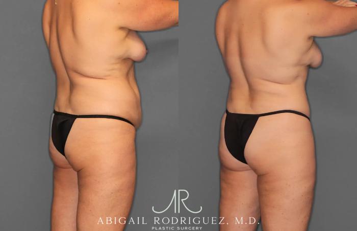 Before & After Tummy Tuck Case 259028 View 7 View in Houston, TX