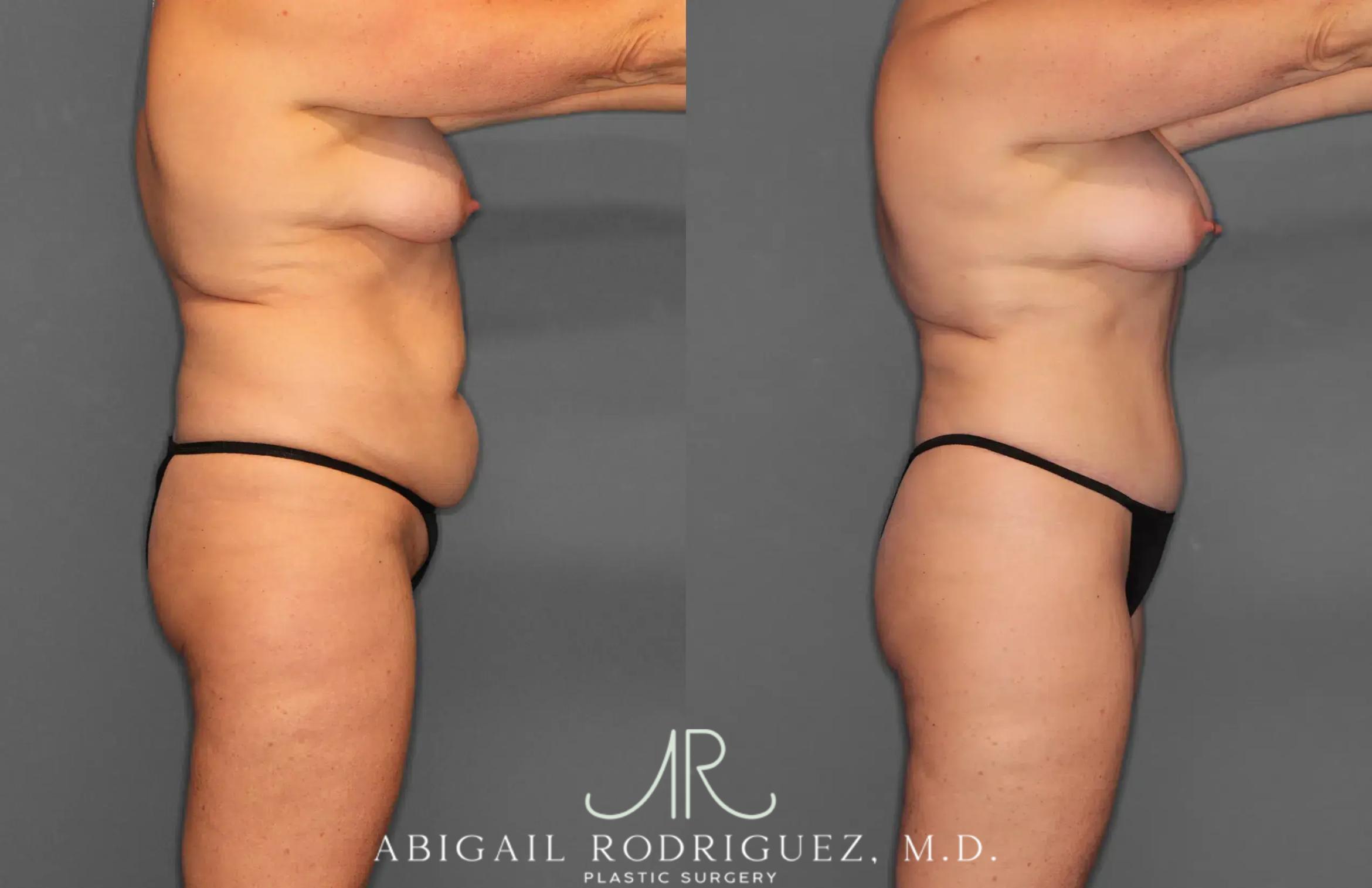 Before & After Tummy Tuck Case 259028 View 8 View in Houston, TX